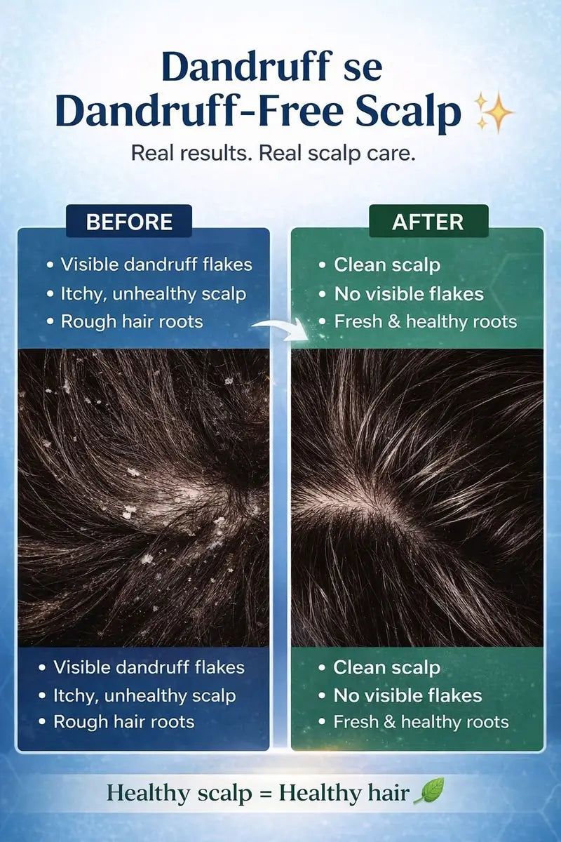 Expected flake-free results timeline for Exo anti-dandruff remedy by Champi Oil.